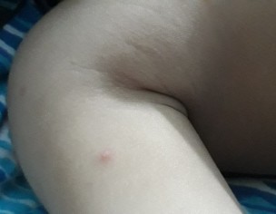 Red Rash/Boils