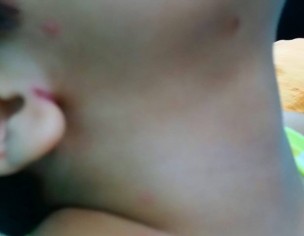 Red Rash/Boils