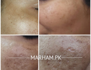 Pigmentation Or Melasma Or Dark Circle From Last Five Year
