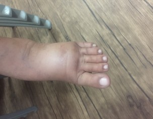 Edema On Right Foot