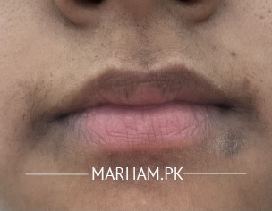 Skin Discolouration 