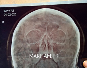 Post Nasal Drip Sinusitis