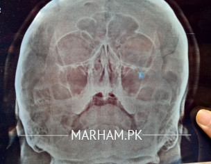 Post Nasal Drip Sinusitis