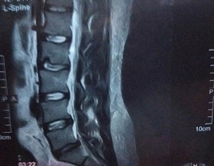 Disc Herniation