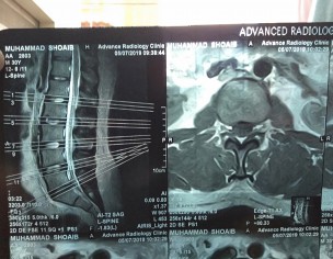 Disc Herniation