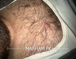 Chest Nodules