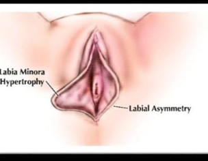 Labia Minora Hypertrophy