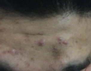 Skin Pimples And Spots, Marks