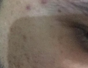 Skin Pimples And Spots, Marks