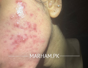 Skin. Acne ,acne Scars