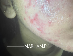 Skin. Acne ,acne Scars