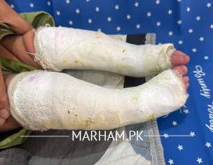 Clubfoot Suggestions 