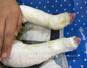 Clubfoot Suggestions 