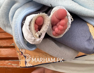 Clubfoot Suggestions 