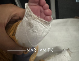 Clubfoot Suggestions 