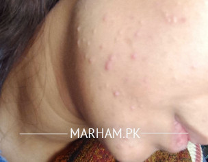 Acne Pus Cyst