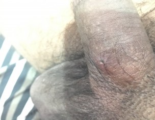 Pimple On Penis