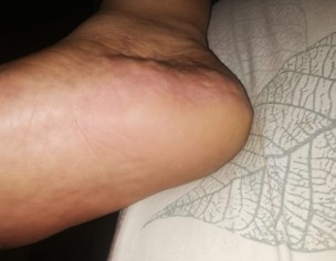 Swelling On Foot