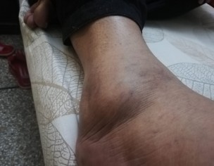 Swelling On Foot