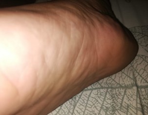 Swelling On Foot