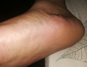 Swelling On Foot