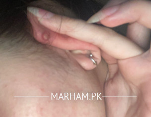 Ear Piercing Infection 
