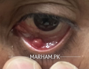 Eye Downside Something.