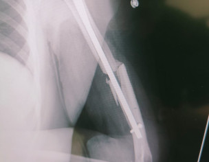 Humerial Fracture