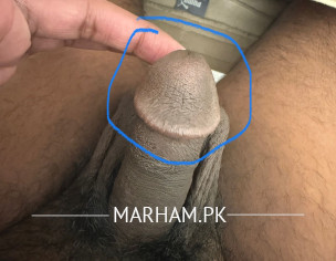 Penis Head Swallow Burning On Left Side &itching