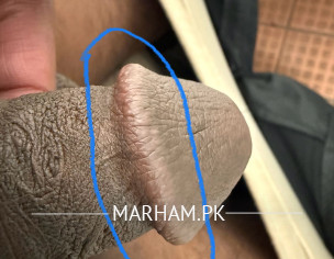 Penis Head Swallow Burning On Left Side &itching