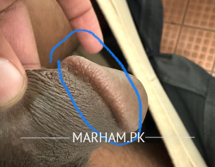 Penis Head Swallow Burning On Left Side &itching