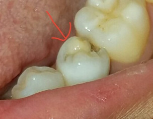 Dental Issue