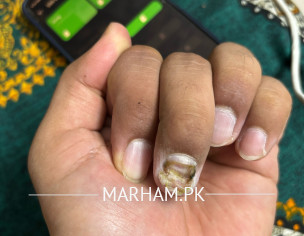 Finger Nail Deformed 