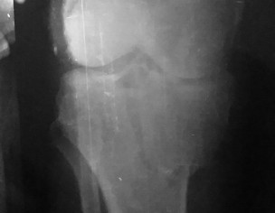 Knee Fracture