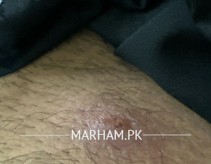 Repeated Styles And Boils.