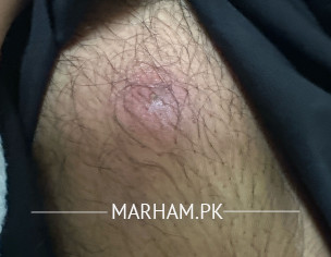 Repeated Styles And Boils.