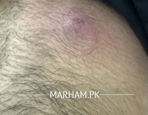 Repeated Styles And Boils.