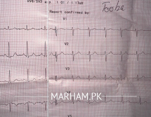 ECG Check And Chest Pain
