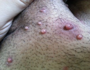 Skin Warts 
