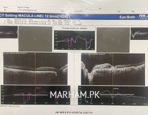 Do Reports Indicate " Macular Edema" ?