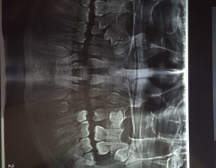 Misalignment In Teeth And Gap