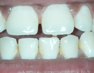 Small Gap Between My Front Teeth Also Lower