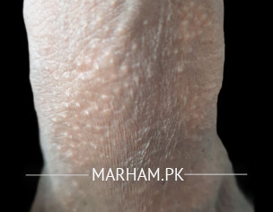 Fordyce Spot And Premature Ejaculation