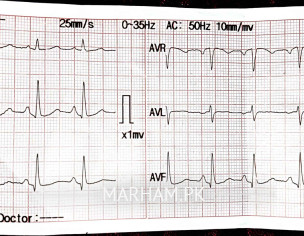 ECG Report