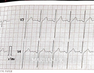ECG Report