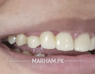 Dental Bridge Mishap