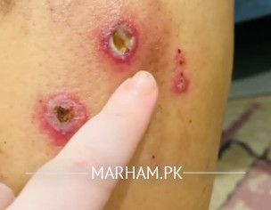 Swelling And Red Patches 