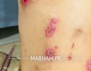 Swelling And Red Patches 