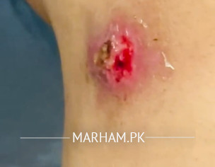 Swelling And Red Patches 