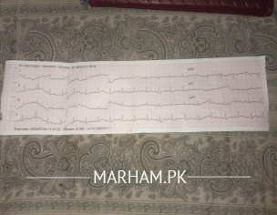 ECG